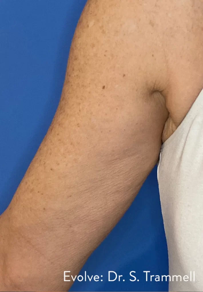 След процедура с апарата Evolve