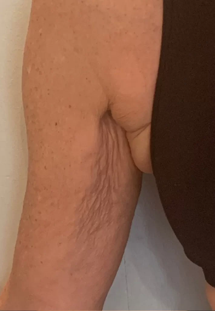 Преди процедура с апарата Evolve