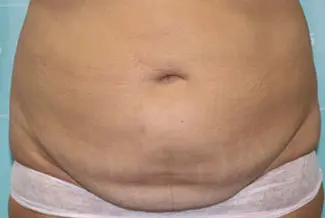 Преди процедура с Cooltech