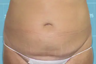 След процедура с Cooltech