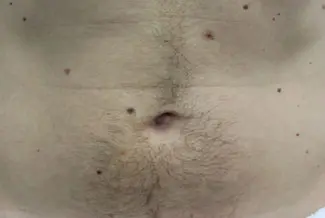 Преди процедура с Elysion Pro