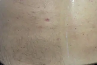 Преди процедура с Elysion Pro