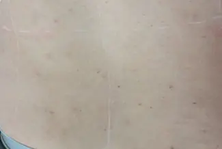 След процедура с Elysion