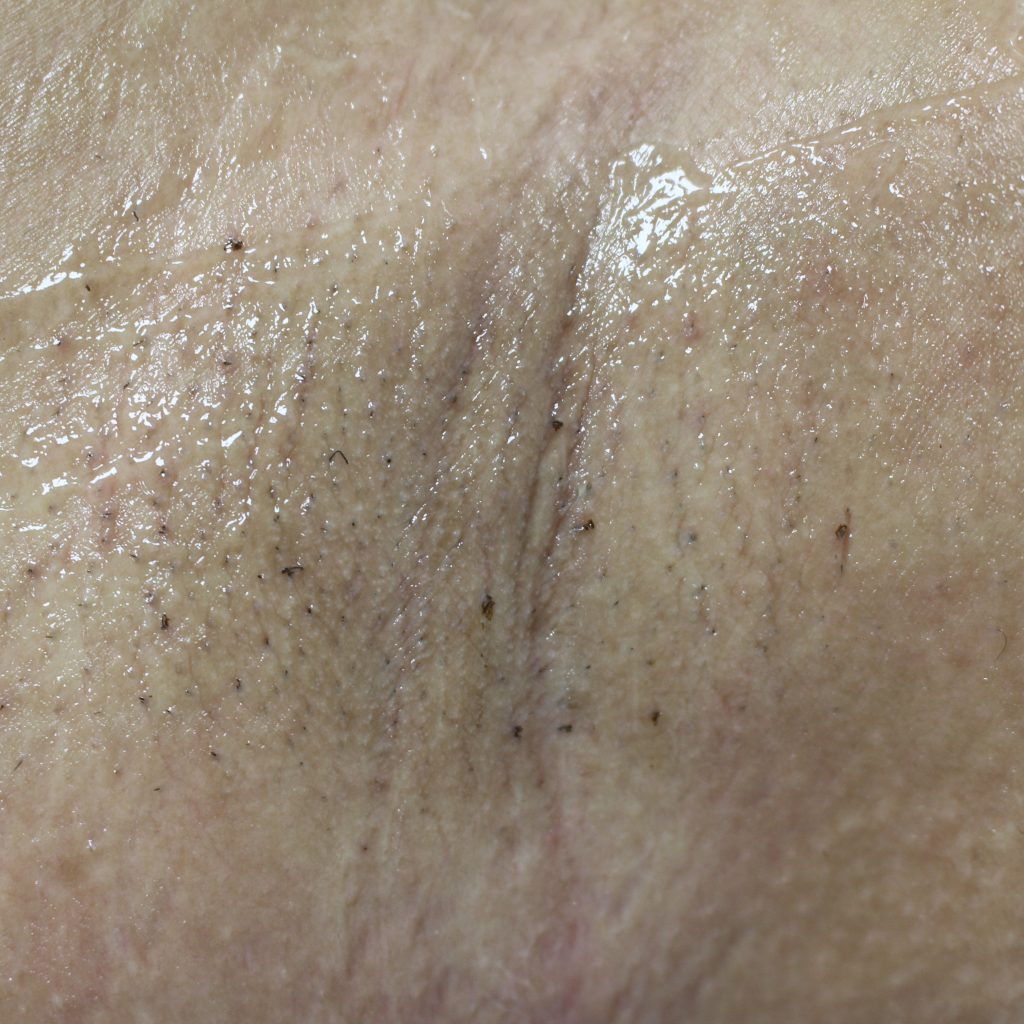 PrimeLase след процедура