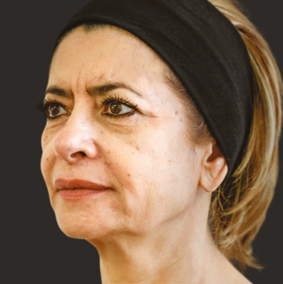 Преди инжектиране на колаген стимулатора Ellanse