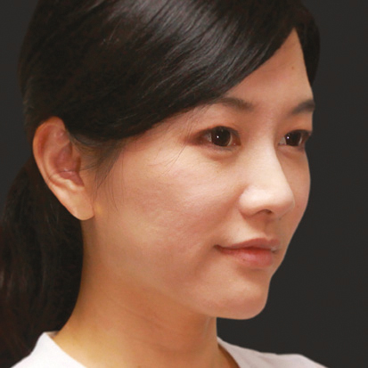 След инжектиране на колаген стимулатора Ellanse