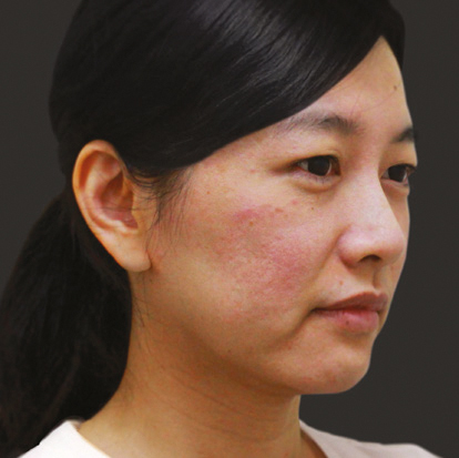 Преди инжектиране на колаген стимулатора Ellanse