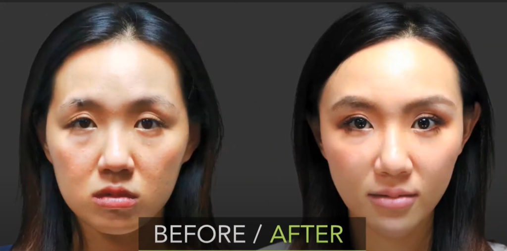 Резултати преди и след Ellanse