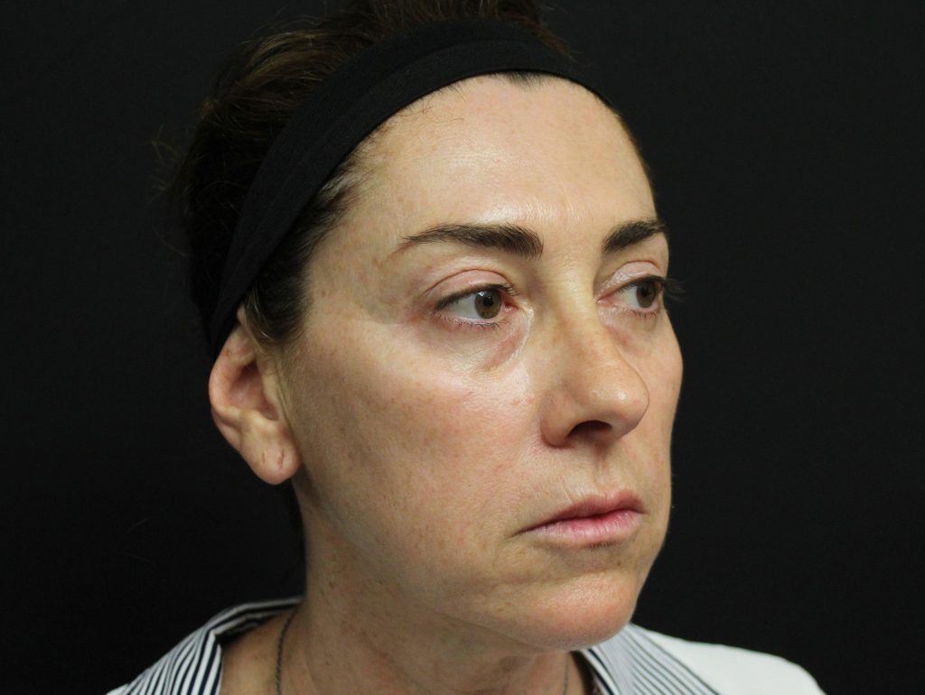 Lanluma колаген стимулатор за лице след инжектиране