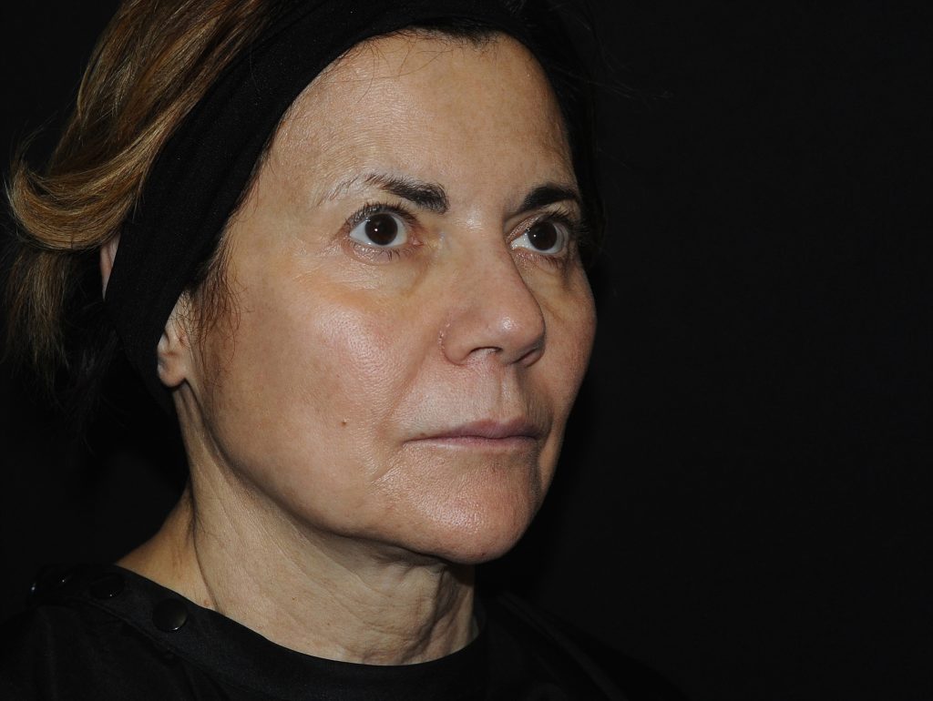 Lanluma колаген стимулатор за лице след инжектиране