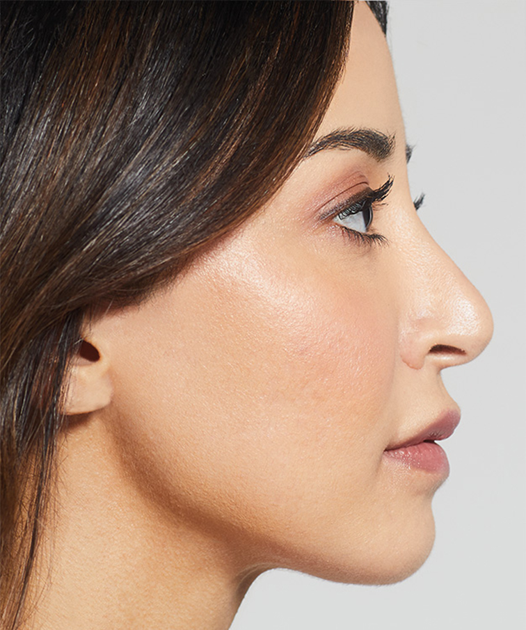 Филър MaiLi след инжекциране на продукта