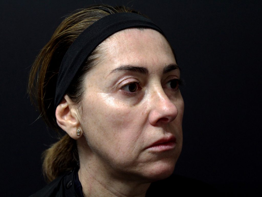 Lanluma колаген стимулатор за лице преди инжектиране