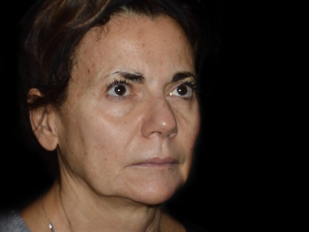 Lanluma колаген стимулатор за лице преди инжектиране