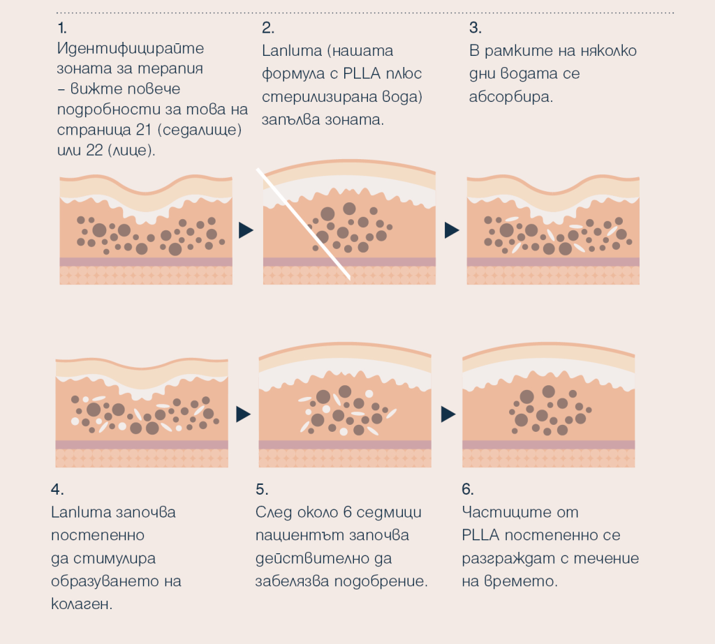 Lanluma колаген стимулатор действие на инжекционния продукт