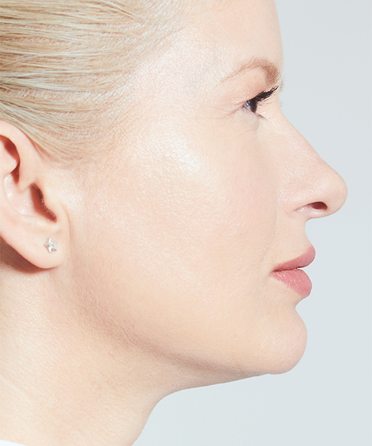 Филър MaiLi след инжекциране на продукта