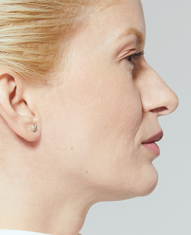 Филър MaiLi преди инжекциране на продукта