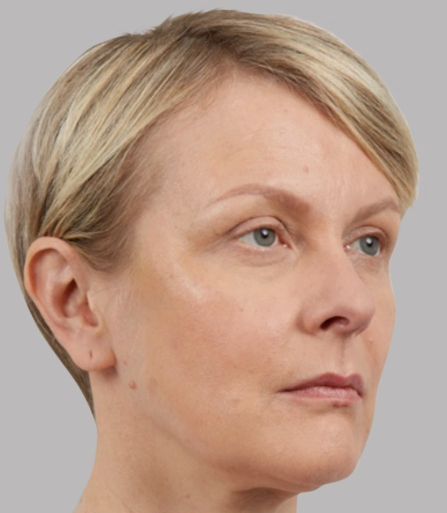 Silhouette Soft повдигащи конци