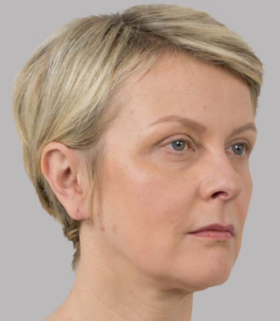 Silhouette Soft повдигащи конци