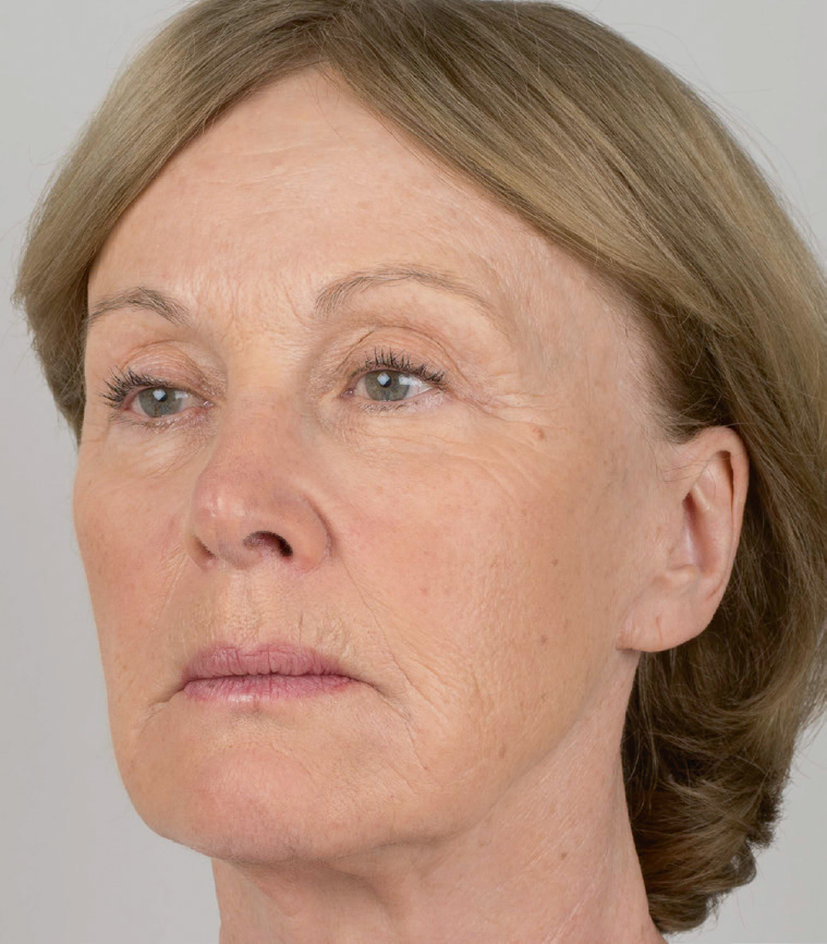 Silhouette Soft повдигащи конци