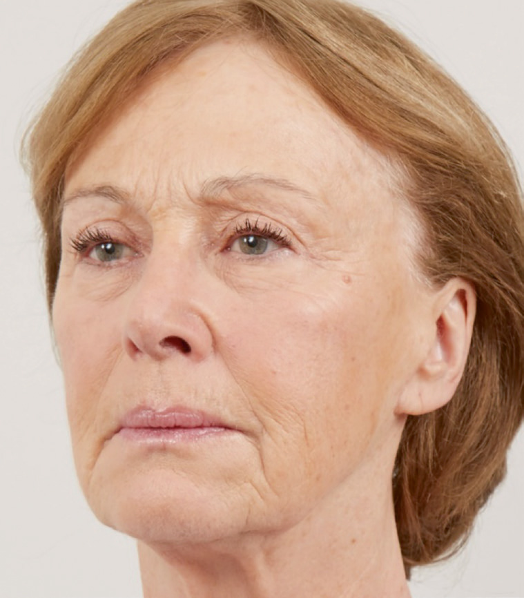 Преди Silhouette Soft повдигащи конци