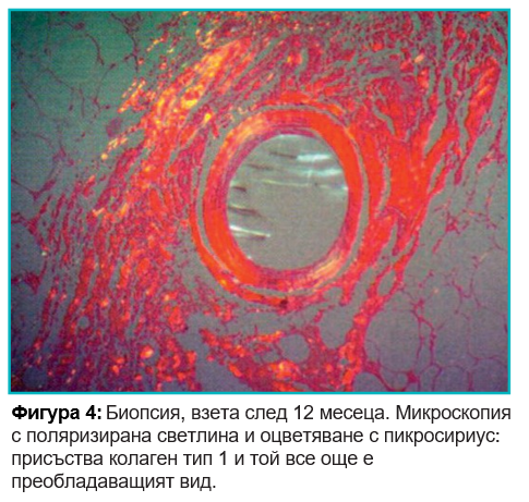 Silhouette Soft повдигащи конци биопсия