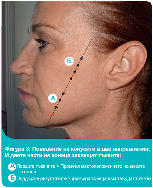 Silhouette Soft повдигащи конци