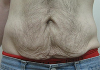 Преди процедура с апарата Viora 10