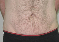 След процедура с апарата Viora 10