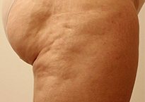 Преди процедура с апарата Viora 10