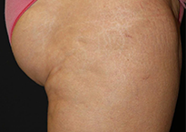 След процедури с апарата Viora 10