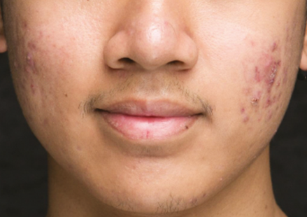 Преди процедура с апарата Viora 10