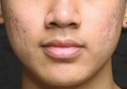 След процедура с апарата Viora 10