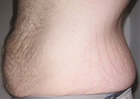 Преди процедура с апарата Viora 10