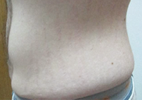 След процедури с апарата Viora 10