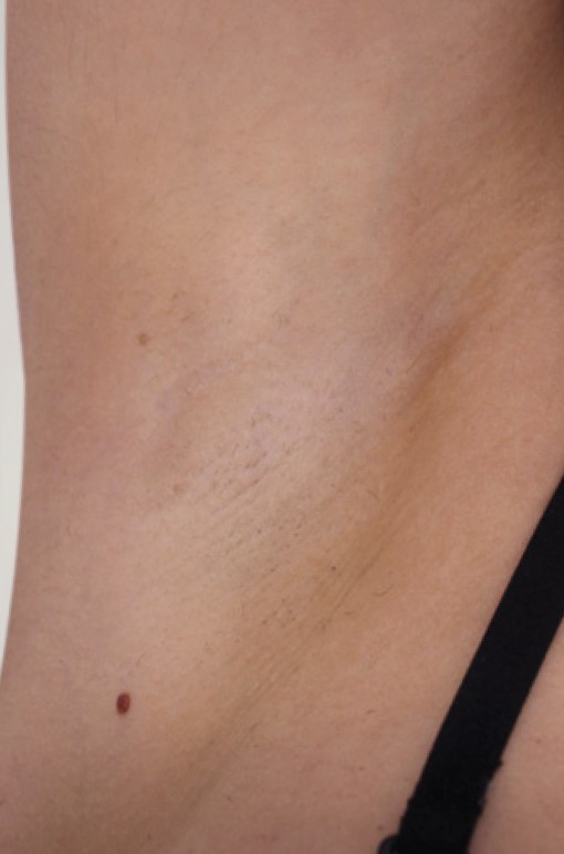 Elysion Pro 3500W апарат за лазерна епилация