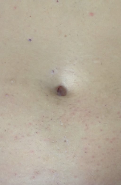 Elysion Pro 3500W апарат за лазерна епилация