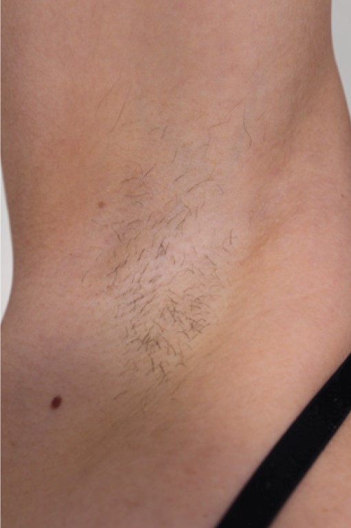 Elysion Pro 3500W апарат за лазерна епилация