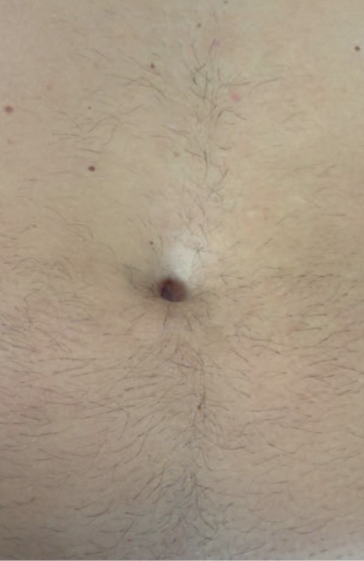 Elysion Pro 3500W апарат за лазерна епилация