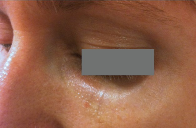 Nordlys клинични резултати