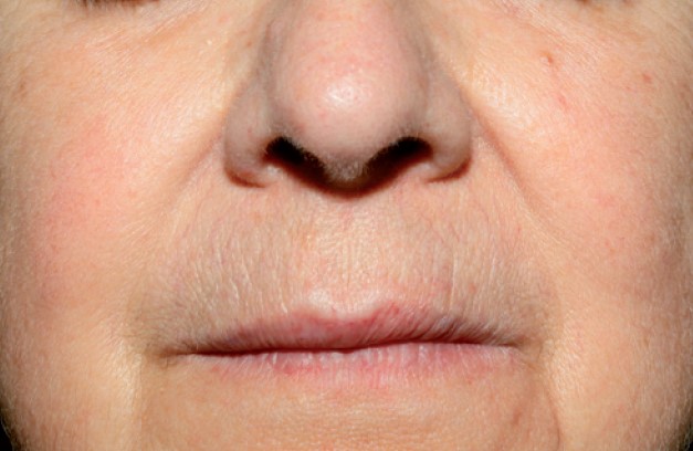 Nordlys клинични резултати