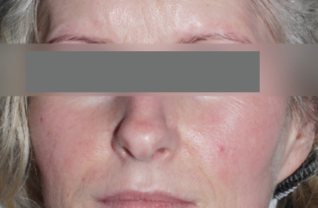 Nordlys клинични резултати