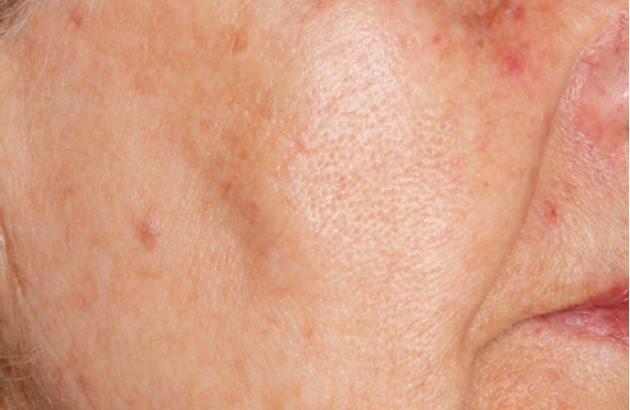 Nordlys клинични резултати