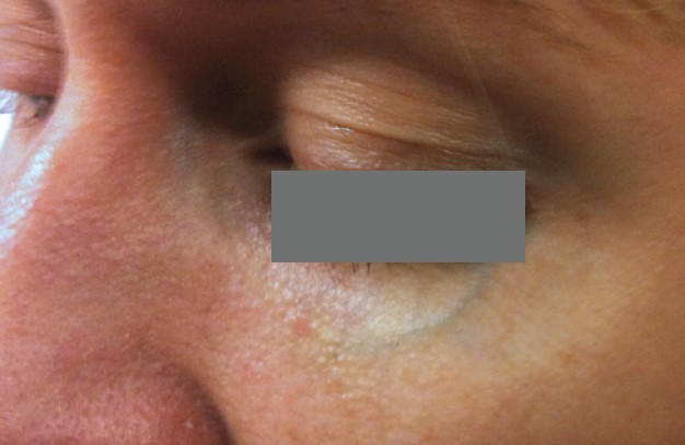 Nordlys клинични резултати