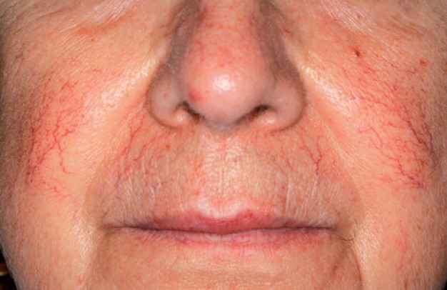 Nordlys клинични резултати