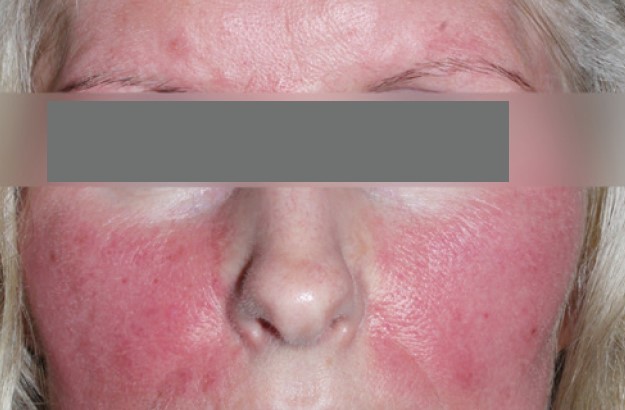 Nordlys клинични резултати