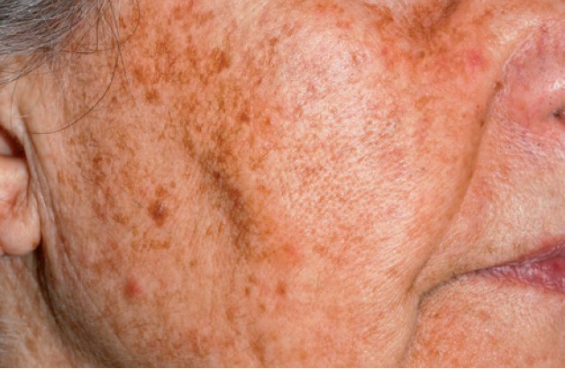 Nordlys клинични резултати