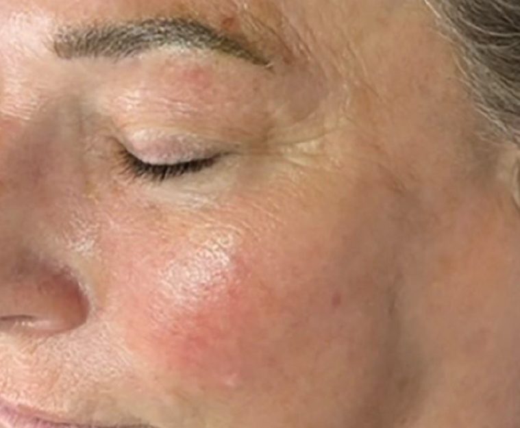 Hydrafacial Syndeo след